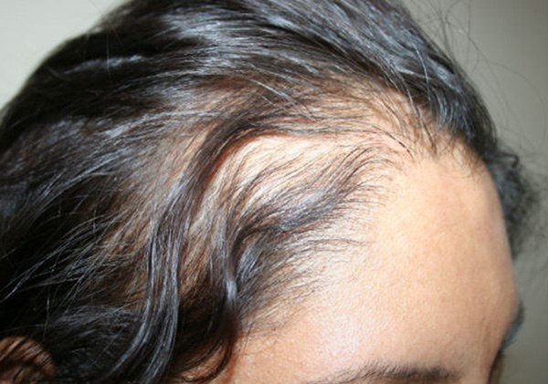 how to regrow hair after laser removal
